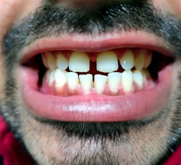 Gaps Between Teeth